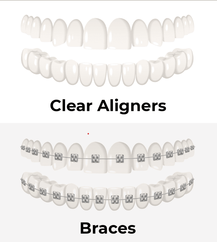 Braces vs Clear Aligners: Choosing the Right Orthodontic Treatment